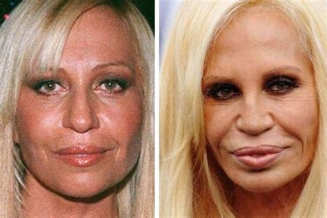 donatella versace mouth|Donatella Versace plastic surgery.